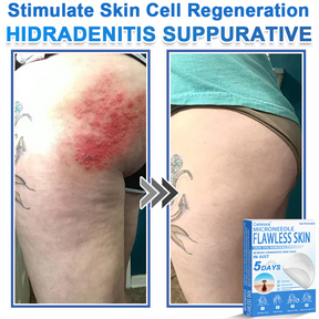 GlowSkin -  2-in-1 Microneedle & Hydrocolloid Star Patch