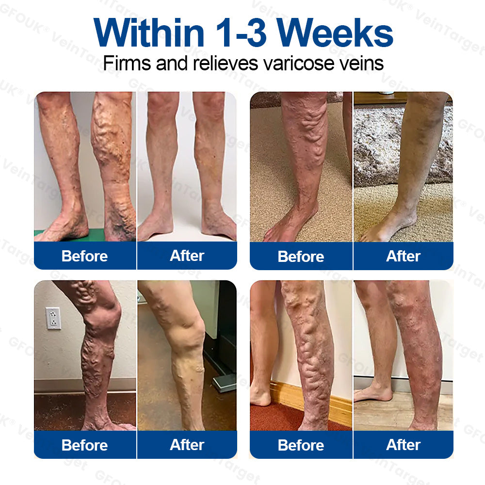 🇺🇸👨‍⚕️✅✅GFOUK® VeinTarget Microneedle Patch⚡Instant Relief, Long-Term Results
