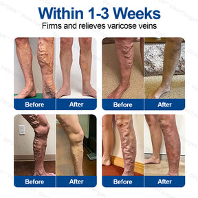 🇺🇸👨‍⚕️✅✅GFOUK® VeinTarget Microneedle Patch⚡Instant Relief, Long-Term Results