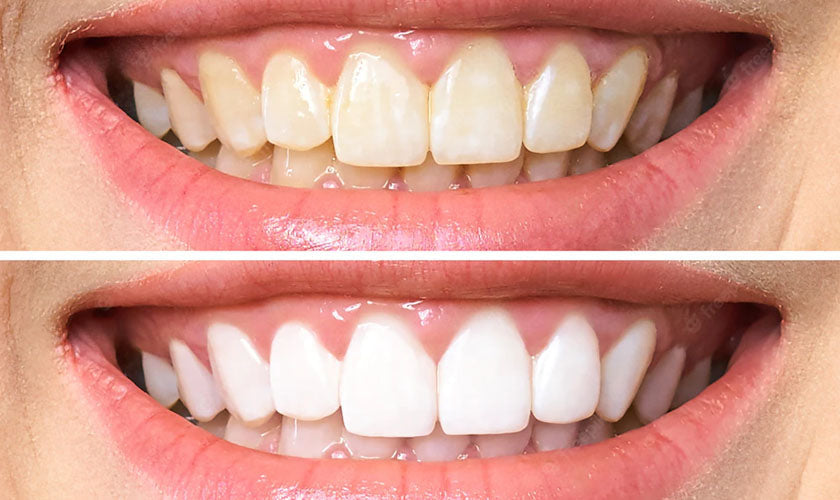 AuraBright – Advanced PAP+ Teeth Whitening Strips