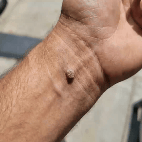 ClearDerma – Microneedle Skin Tag Removal Patch