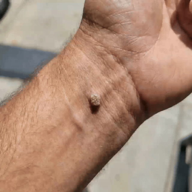 ClearDerma – Microneedle Skin Tag Removal Patch