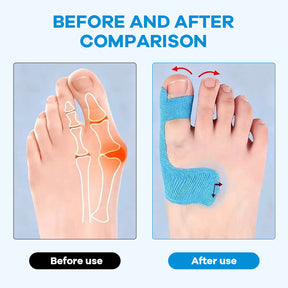 StepEase – Bunion Corrector Kinesiology Tape