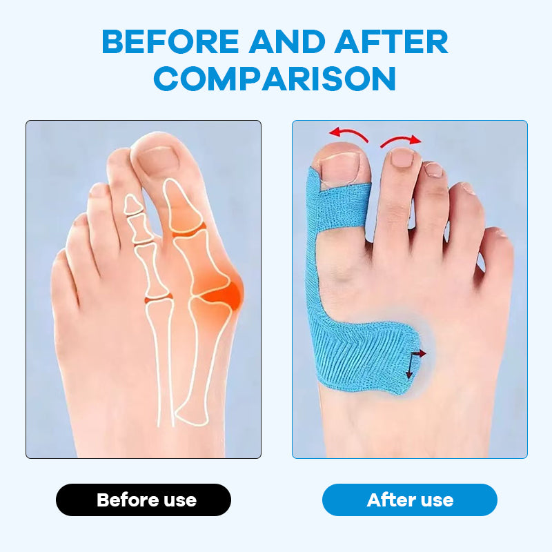 StepEase – Bunion Corrector Kinesiology Tape