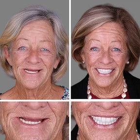 SmileLock – Premium Full Denture Solution