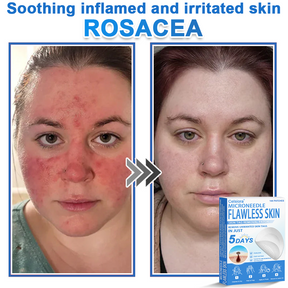 GlowSkin -  2-in-1 Microneedle & Hydrocolloid Star Patch