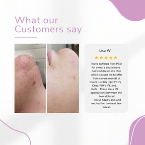 GlowEase - IPL Hair Remover for Effortless Smooth Skin