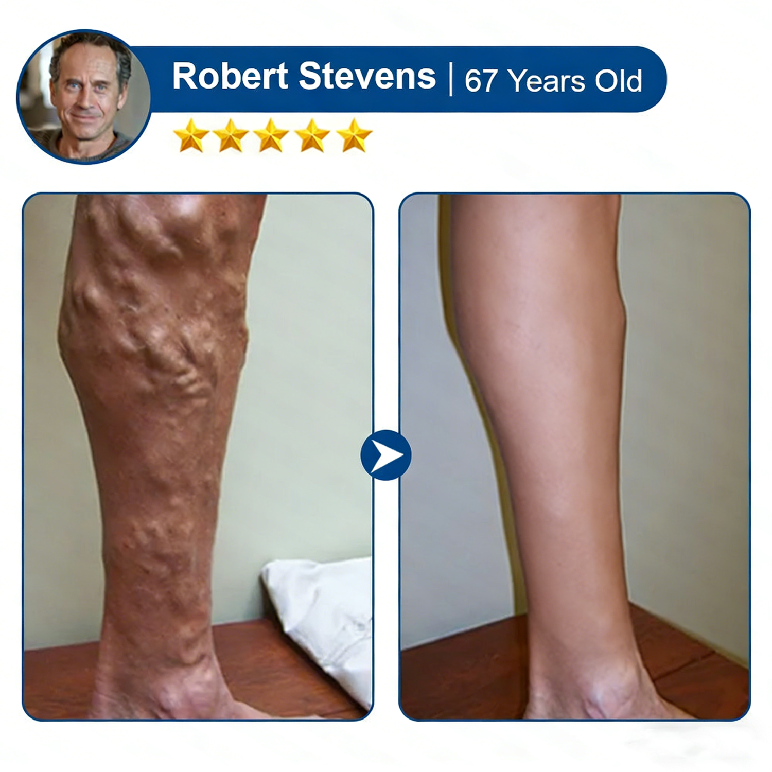 LegEase – Comfortable Vein Care Patch System