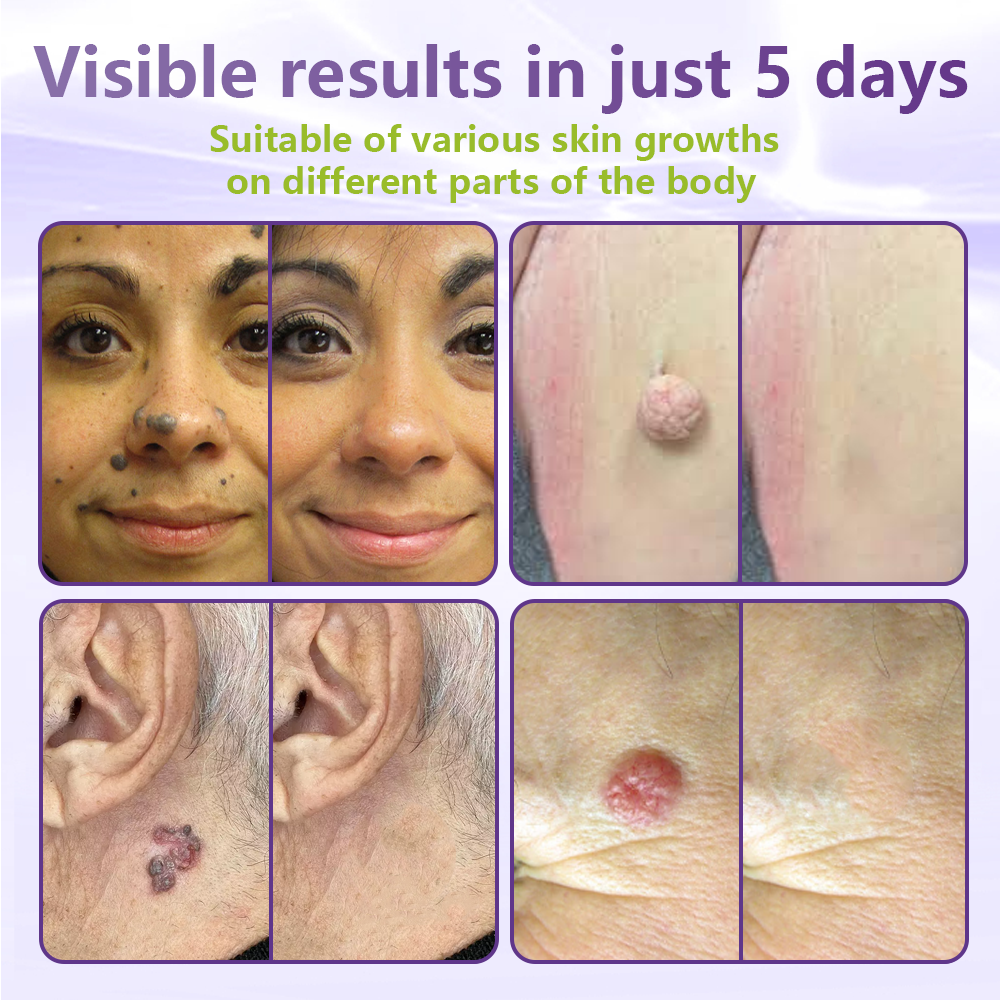 ClearDerma – Microneedle Skin Tag Removal Patch
