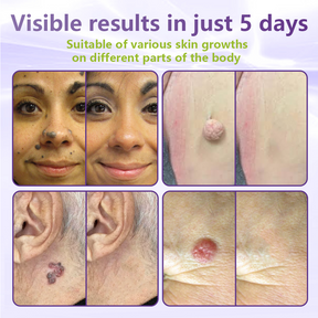 ClearDerma – Microneedle Skin Tag Removal Patch