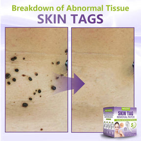 ClearDerma – Microneedle Skin Tag Removal Patch