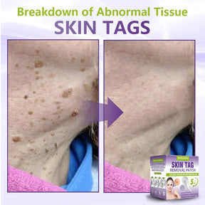 ClearDerma – Microneedle Skin Tag Removal Patch