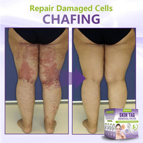 ClearDerma – Microneedle Skin Tag Removal Patch