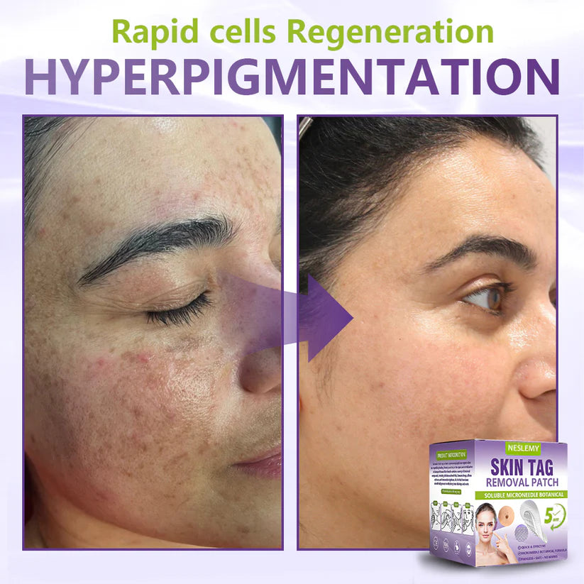 ClearDerma – Microneedle Skin Tag Removal Patch