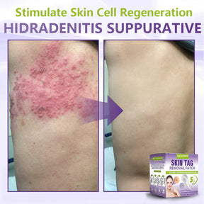 ClearDerma – Microneedle Skin Tag Removal Patch