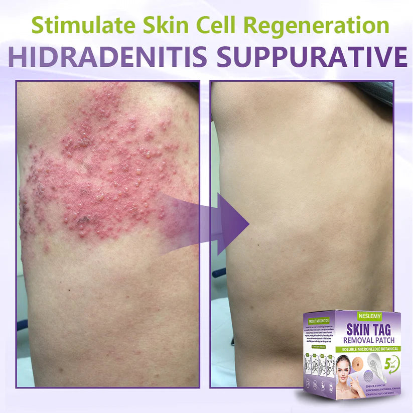 ClearDerma – Microneedle Skin Tag Removal Patch