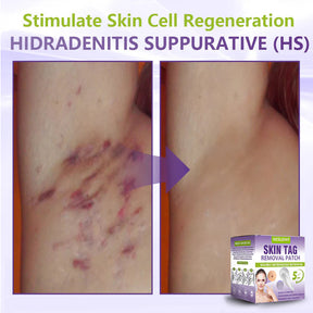 ClearDerma – Microneedle Skin Tag Removal Patch