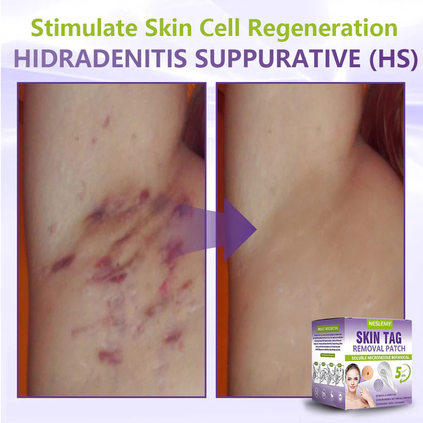 ClearDerma – Microneedle Skin Tag Removal Patch