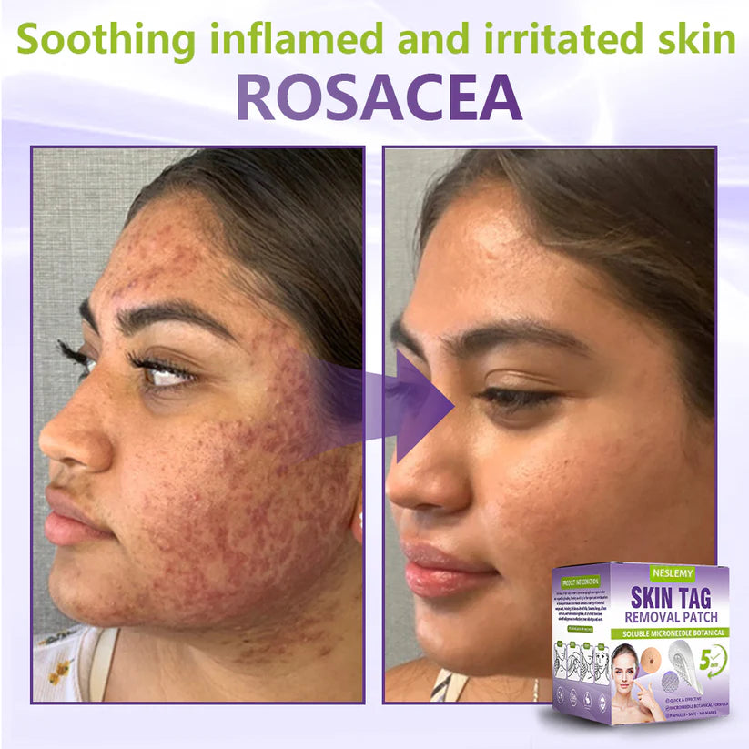 ClearDerma – Microneedle Skin Tag Removal Patch