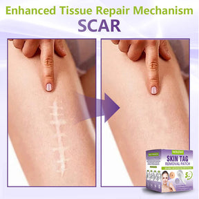 ClearDerma – Microneedle Skin Tag Removal Patch