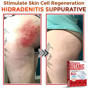 Natrvor –2-in-1  Microneedle Botanical Skin Renewal Patch