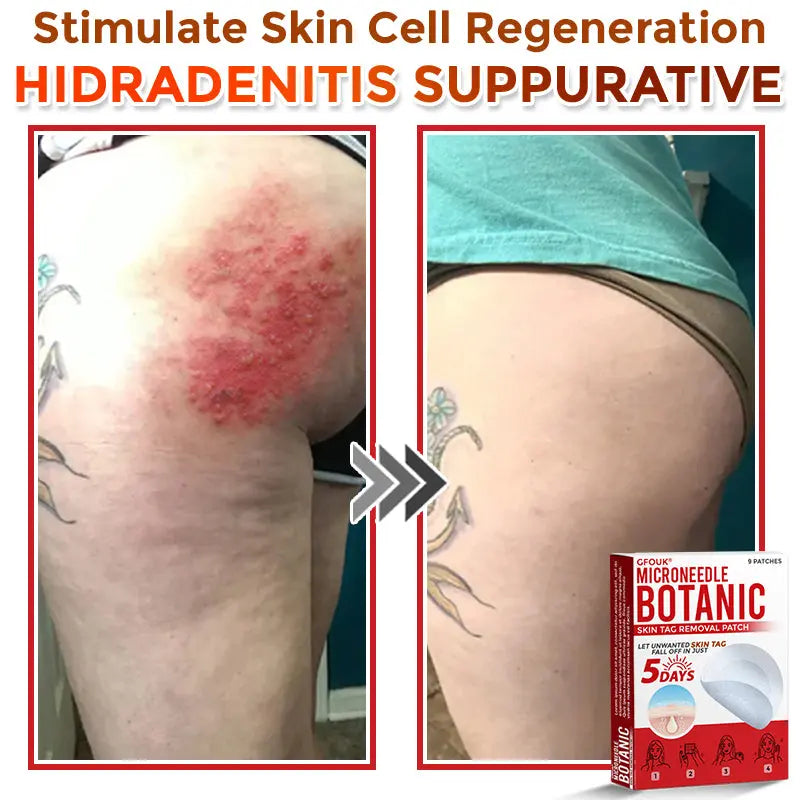 Natrvor –2-in-1  Microneedle Botanical Skin Renewal Patch