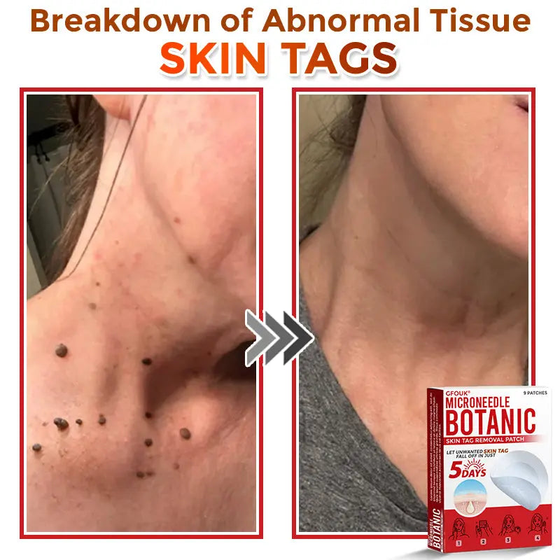 Natrvor –2-in-1  Microneedle Botanical Skin Renewal Patch