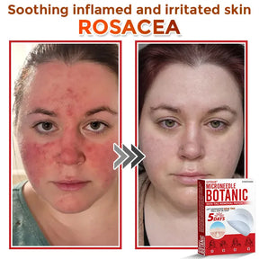 Natrvor –2-in-1  Microneedle Botanical Skin Renewal Patch