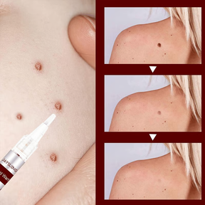 ClearGuard – Effective Wart Removal Pen