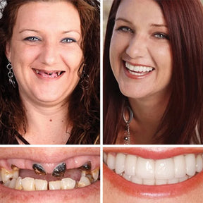🌎Ends Today: 70% OFF! ⏰Yagoo™ Medical Full Denture with Strong Suctiond🦷Obtain American Dental Association (ADA) Certification