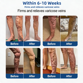 LegEase – Comfortable Vein Care Patch System