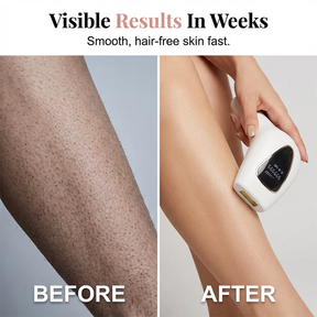 LumiSmooth – Painless Hair Removal Device for Women