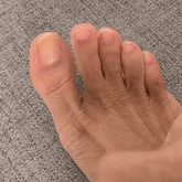 LaserNail Pro | Treatment Against Funghis