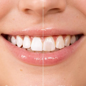 WhiteBloom – Instant Smile Brightener