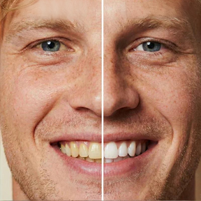 WhiteBloom – Instant Smile Brightener