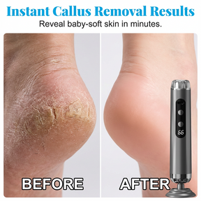 HeelRenew – Foot Callus Remover Soft Skin Solution