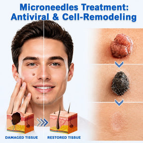 SkinNova – Dual Action Microneedle Acne Patch