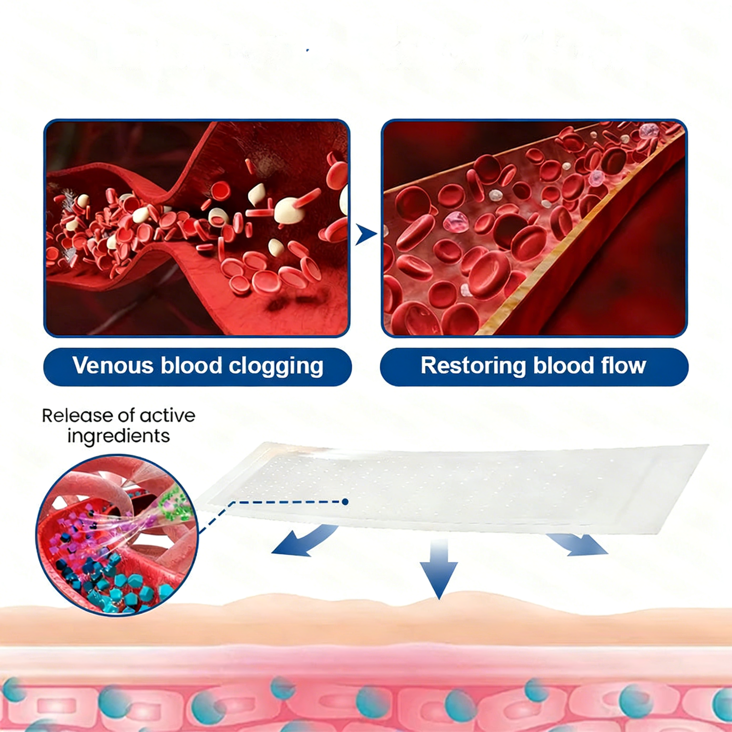 LegEase – Comfortable Vein Care Patch System